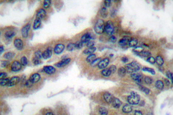 DNAJB1 / Hsp40 Antibody - IHC of HSP40/HDJ-1 (P303) pAb in paraffin-embedded lung carcinoma tissue.
