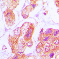 DNAJB11 Antibody - Immunohistochemical analysis of DNAJB11 staining in human lung cancer formalin fixed paraffin embedded tissue section. The section was pre-treated using heat mediated antigen retrieval with sodium citrate buffer (pH 6.0). The section was then incubated with the antibody at room temperature and detected using an HRP conjugated compact polymer system. DAB was used as the chromogen. The section was then counterstained with hematoxylin and mounted with DPX.