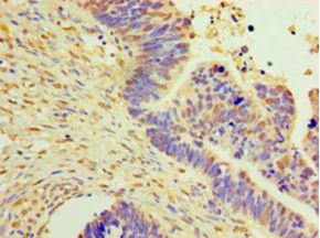 DNAJB2 Antibody - Immunohistochemistry of paraffin-embedded human ovarian cancer tissue using antibody at 1:100 dilution.  This image was taken for the unconjugated form of this product. Other forms have not been tested.