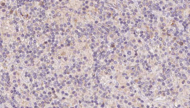 DNAJB3 Antibody - 1:100 staining human lymph carcinoma tissue by IHC-P. The sample was formaldehyde fixed and a heat mediated antigen retrieval step in citrate buffer was performed. The sample was then blocked and incubated with the antibody for 1.5 hours at 22°C. An HRP conjugated goat anti-rabbit antibody was used as the secondary.