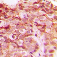 DNAJB4 Antibody - Immunohistochemical analysis of DNAJB4 staining in human breast cancer formalin fixed paraffin embedded tissue section. The section was pre-treated using heat mediated antigen retrieval with sodium citrate buffer (pH 6.0). The section was then incubated with the antibody at room temperature and detected with HRP and DAB as chromogen. The section was then counterstained with hematoxylin and mounted with DPX.