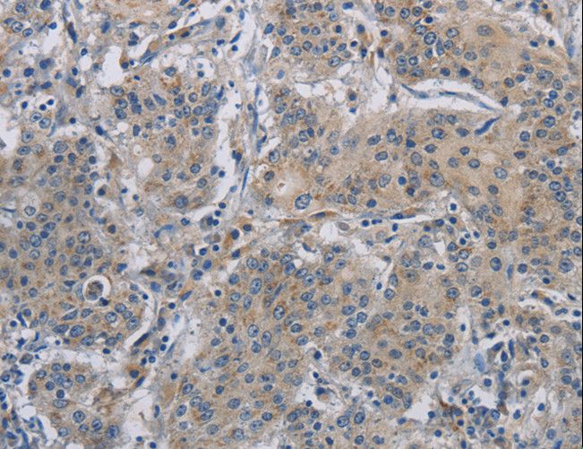 DNAJB4 Antibody - Immunohistochemistry of paraffin-embedded Human gastric cancer using DNAJB4 Polyclonal Antibody at dilution of 1:50.