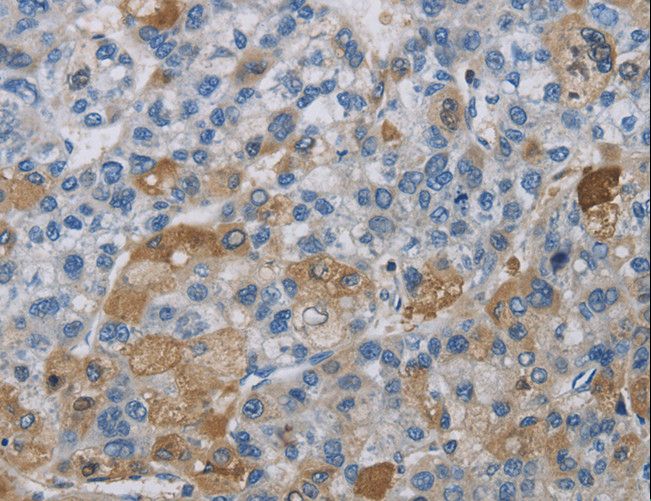 DNAJB4 Antibody - Immunohistochemistry of paraffin-embedded Human liver cancer using DNAJB4 Polyclonal Antibody at dilution of 1:50.