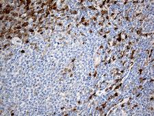 DNAJB5 Antibody - Immunohistochemical staining of paraffin-embedded Human lymphoma tissue using anti-DNAJB5 mouse monoclonal antibody. (Heat-induced epitope retrieval by 1mM EDTA in 10mM Tris buffer. (pH8.5) at 120°C for 3 min. (1:500)
