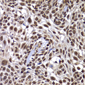 DNAJB6 Antibody - Immunohistochemistry of paraffin-embedded human well-differentiated squamous skin carcinoma tissue.