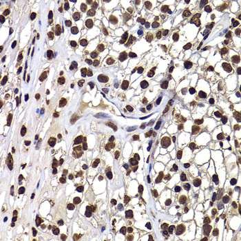 DNAJB6 Antibody - Immunohistochemistry of paraffin-embedded human kidney cancer tissue.
