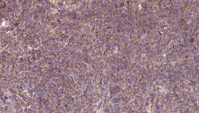 DNAJC10 Antibody - 1:100 staining human lymph carcinoma tissue by IHC-P. The sample was formaldehyde fixed and a heat mediated antigen retrieval step in citrate buffer was performed. The sample was then blocked and incubated with the antibody for 1.5 hours at 22°C. An HRP conjugated goat anti-rabbit antibody was used as the secondary.