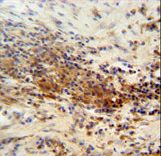 DNAJC11 Antibody - DNAJC11 antibody immunohistochemistry of formalin-fixed and paraffin-embedded human lung carcinoma followed by peroxidase-conjugated secondary antibody and DAB staining.