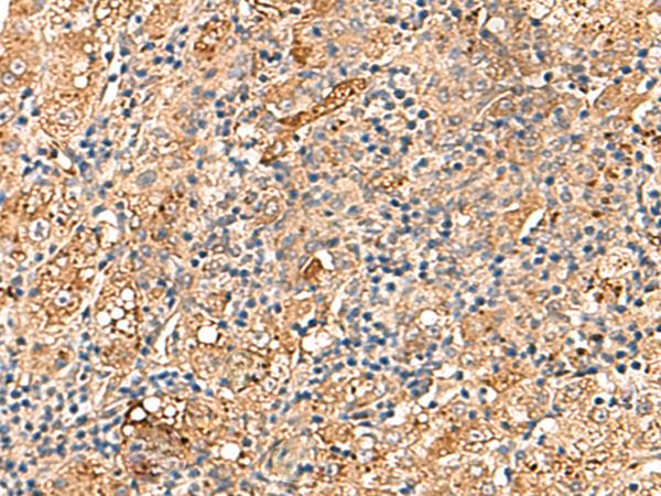 DNAJC14 Antibody - Immunohistochemistry of paraffin-embedded Human liver cancer tissue  using DNAJC14 Polyclonal Antibody at dilution of 1:70(×200)