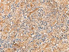 DNAJC14 Antibody - Immunohistochemistry of paraffin-embedded Human liver cancer tissue  using DNAJC14 Polyclonal Antibody at dilution of 1:70(×200)