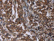 DNAJC15 Antibody - Immunohistochemistry of paraffin-embedded Human liver cancer using DNAJC15 Polyclonal Antibody at dilution of 1:40.