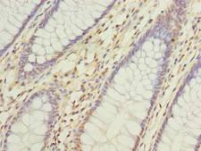 DNAJC17 Antibody - Immunohistochemistry of paraffin-embedded human colon cancer using antibody at dilution of 1:100.