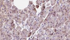 DNAJC19 Antibody - 1:100 staining human pancreas carcinoma tissue by IHC-P. The sample was formaldehyde fixed and a heat mediated antigen retrieval step in citrate buffer was performed. The sample was then blocked and incubated with the antibody for 1.5 hours at 22°C. An HRP conjugated goat anti-rabbit antibody was used as the secondary.