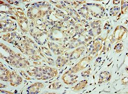 DNAJC2 / ZRF1 Antibody - Immunohistochemistry of paraffin-embedded human breast cancer using antibody at 1:100 dilution.
