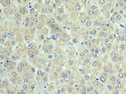 DNAJC2 / ZRF1 Antibody - Immunohistochemistry of paraffin-embedded human liver cancer using antibody at 1:100 dilution.
