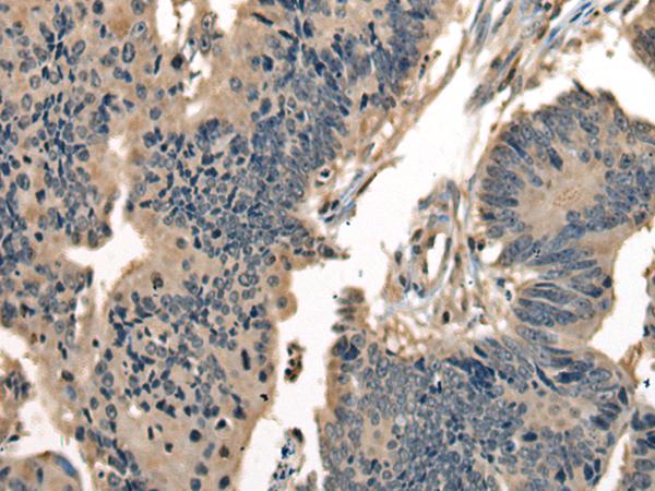 DNAJC2 / ZRF1 Antibody - Immunohistochemistry of paraffin-embedded Human colorectal cancer tissue  using DNAJC2 Polyclonal Antibody at dilution of 1:40(×200)