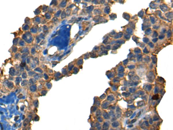 DNAJC2 / ZRF1 Antibody - Immunohistochemistry of paraffin-embedded Human ovarian cancer tissue  using DNAJC2 Polyclonal Antibody at dilution of 1:40(×200)