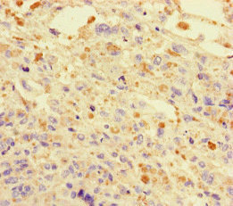 DNAJC3 / p58IPK Antibody - Immunohistochemistry of paraffin-embedded human melanoma cancer at dilution of 1:100