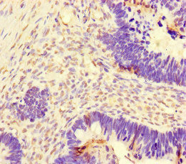 DNAJC3 / p58IPK Antibody - Immunohistochemistry of paraffin-embedded human ovarian cancer at dilution of 1:100
