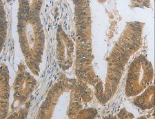 DNAJC7 Antibody - Immunohistochemistry of paraffin-embedded Human colon cancer using DNAJC7 Polyclonal Antibody at dilution of 1:25.