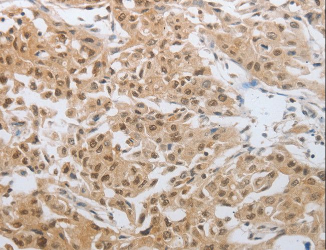 DNAJC7 Antibody - Immunohistochemistry of paraffin-embedded Human lung cancer using DNAJC7 Polyclonal Antibody at dilution of 1:25.