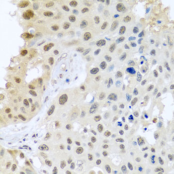 DNAL1 Antibody - Immunohistochemistry of paraffin-embedded human lung cancer tissue.