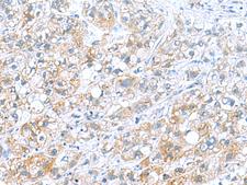 DNAL1 Antibody - Immunohistochemistry of paraffin-embedded Human liver cancer tissue  using DNAL1 Polyclonal Antibody at dilution of 1:70(×200)