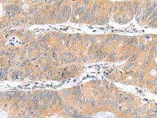 DNAL1 Antibody - Immunohistochemistry of paraffin-embedded Human colorectal cancer tissue  using DNAL1 Polyclonal Antibody at dilution of 1:50(×200)