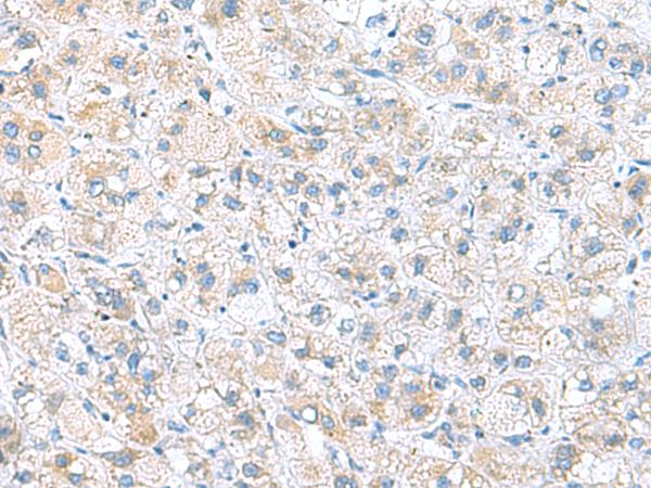 DNAL1 Antibody - Immunohistochemistry of paraffin-embedded Human liver cancer tissue  using DNAL1 Polyclonal Antibody at dilution of 1:50(×200)