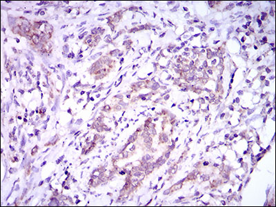 DNAL4 / Dynein Light Chain 4 Antibody - IHC of paraffin-embedded cervical cancer tissues using DNAL4 mouse monoclonal antibody with DAB staining.