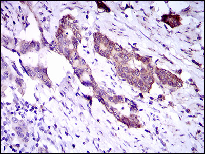 DNAL4 / Dynein Light Chain 4 Antibody - IHC of paraffin-embedded esophageal cancer tissues using DNAL4 mouse monoclonal antibody with DAB staining.