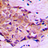 DNAL4 / Dynein Light Chain 4 Antibody - Immunohistochemical analysis of DNAL4 staining in human breast cancer formalin fixed paraffin embedded tissue section. The section was pre-treated using heat mediated antigen retrieval with sodium citrate buffer (pH 6.0). The section was then incubated with the antibody at room temperature and detected using an HRP conjugated compact polymer system. DAB was used as the chromogen. The section was then counterstained with hematoxylin and mounted with DPX.