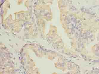 DNALI1 Antibody - Immunohistochemistry of paraffin-embedded human prostate cancer using antibody at dilution of 1:100.