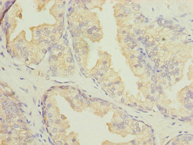 DNALI1 Antibody - Immunohistochemistry of paraffin-embedded human prostate cancer using DNALI1 Antibody at dilution of 1:100