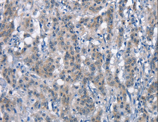 DNAM-1 / CD226 Antibody - Immunohistochemistry of paraffin-embedded Human gastric cancer using CD226 Polyclonal Antibody at dilution of 1:60.