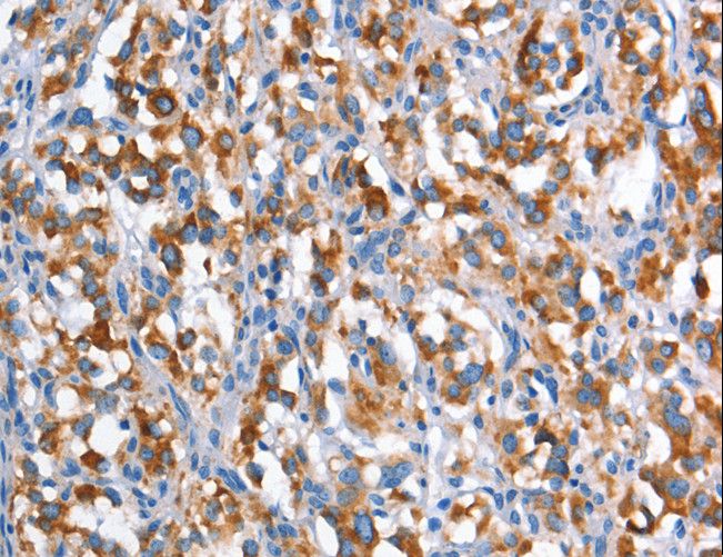 DNAM-1 / CD226 Antibody - Immunohistochemistry of paraffin-embedded Human gastric cancer using CD226 Polyclonal Antibody at dilution of 1:60.