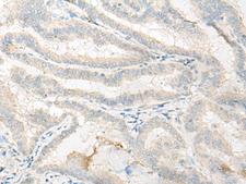 DNASE1L1 Antibody - Immunohistochemistry of paraffin-embedded Human thyroid cancer tissue  using DNASE1L1 Polyclonal Antibody at dilution of 1:25(×200)