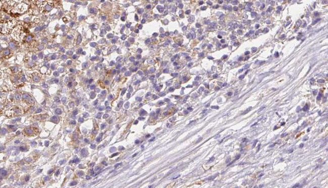 DNER / BET Antibody - 1:100 staining human liver carcinoma tissues by IHC-P. The sample was formaldehyde fixed and a heat mediated antigen retrieval step in citrate buffer was performed. The sample was then blocked and incubated with the antibody for 1.5 hours at 22°C. An HRP conjugated goat anti-rabbit antibody was used as the secondary.