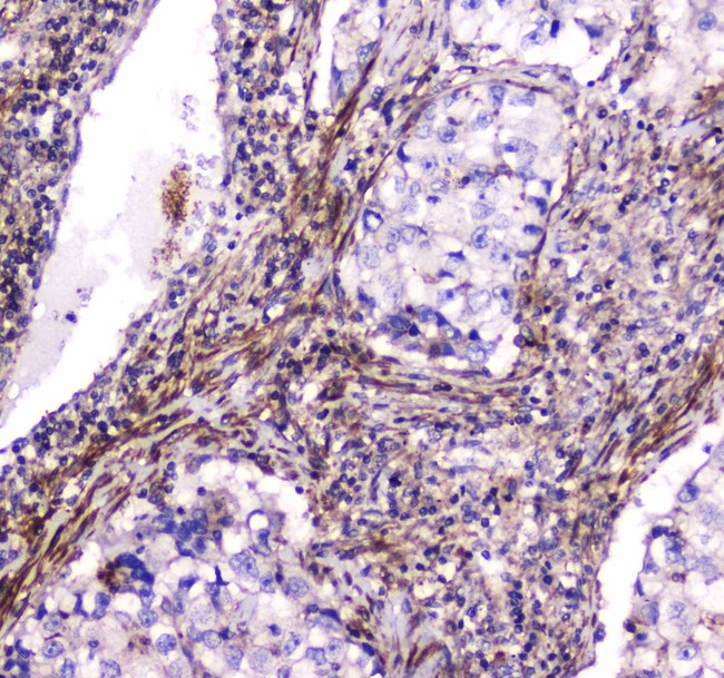 DNM1 / Dynamin Antibody - IHC analysis of Dynamin 1 using anti-Dynamin 1 antibody. Dynamin 1 was detected in paraffin-embedded section of human lung cancer tissue. Heat mediated antigen retrieval was performed in citrate buffer (pH6, epitope retrieval solution) for 20 mins. The tissue section was blocked with 10% goat serum. The tissue section was then incubated with 1µg/ml rabbit anti-Dynamin 1 Antibody overnight at 4°C. Biotinylated goat anti-rabbit IgG was used as secondary antibody and incubated for 30 minutes at 37°C. The tissue section was developed using Strepavidin-Biotin-Complex (SABC) with DAB as the chromogen.