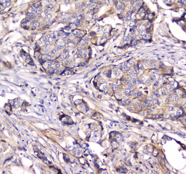 DNM1 / Dynamin Antibody - IHC analysis of Dynamin 1 using anti-Dynamin 1 antibody. Dynamin 1 was detected in paraffin-embedded section of human mammary cancer tissue. Heat mediated antigen retrieval was performed in citrate buffer (pH6, epitope retrieval solution) for 20 mins. The tissue section was blocked with 10% goat serum. The tissue section was then incubated with 1µg/ml rabbit anti-Dynamin 1 Antibody overnight at 4°C. Biotinylated goat anti-rabbit IgG was used as secondary antibody and incubated for 30 minutes at 37°C. The tissue section was developed using Strepavidin-Biotin-Complex (SABC) with DAB as the chromogen.