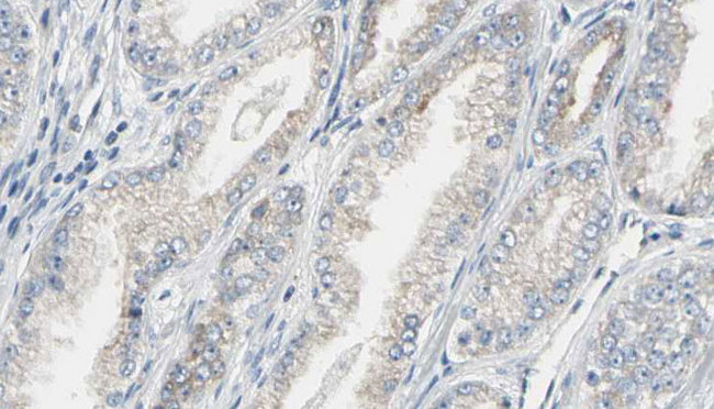 DNM1 / Dynamin Antibody - 1:100 staining human prostate tissue by IHC-P. The sample was formaldehyde fixed and a heat mediated antigen retrieval step in citrate buffer was performed. The sample was then blocked and incubated with the antibody for 1.5 hours at 22°C. An HRP conjugated goat anti-rabbit antibody was used as the secondary.
