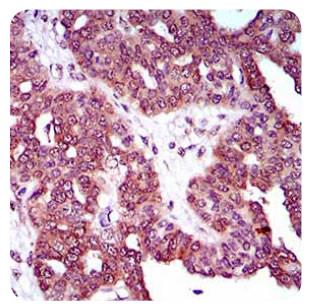 DNM1L / DRP1 Antibody - Immunohistochemistry: DRP1 Antibody (4E11B11) - IHC analysis of paraffin-embedded human ovarian cancer tissues using DRP1 mouse mAb with DAB staining.  This image was taken for the unconjugated form of this product. Other forms have not been tested.