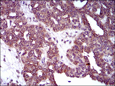 DNM1L / DRP1 Antibody - IHC of paraffin-embedded ovarian cancer tissues using DNM1L mouse monoclonal antibody with DAB staining.