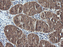 DNM1L / DRP1 Antibody - IHC of paraffin-embedded Adenocarcinoma of Human ovary tissue using anti-DNM1L mouse monoclonal antibody. (Heat-induced epitope retrieval by 10mM citric buffer, pH6.0, 120°C for 3min).