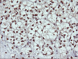 DNM1L / DRP1 Antibody - IHC of paraffin-embedded Carcinoma of Human kidney tissue using anti-DNM1L mouse monoclonal antibody.