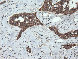 DNM1L / DRP1 Antibody - IHC of paraffin-embedded Carcinoma of Human bladder tissue using anti-DNM1L mouse monoclonal antibody.
