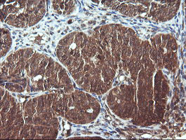 DNM1L / DRP1 Antibody - IHC of paraffin-embedded Adenocarcinoma of Human ovary tissue using anti-DNM1L mouse monoclonal antibody.