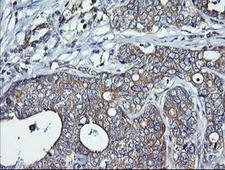 DNM1L / DRP1 Antibody - IHC of paraffin-embedded Adenocarcinoma of Human breast tissue using anti-DNM1L mouse monoclonal antibody. (Heat-induced epitope retrieval by 10mM citric buffer, pH6.0, 120°C for 3min).