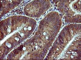 DNM1L / DRP1 Antibody - IHC of paraffin-embedded Carcinoma of Human pancreas tissue using anti-DNM1L mouse monoclonal antibody. (Heat-induced epitope retrieval by 10mM citric buffer, pH6.0, 120°C for 3min).