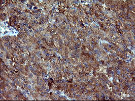 DNM1L / DRP1 Antibody - IHC of paraffin-embedded Carcinoma of Human thyroid tissue using anti-DNM1L mouse monoclonal antibody. (Heat-induced epitope retrieval by 10mM citric buffer, pH6.0, 120°C for 3min).